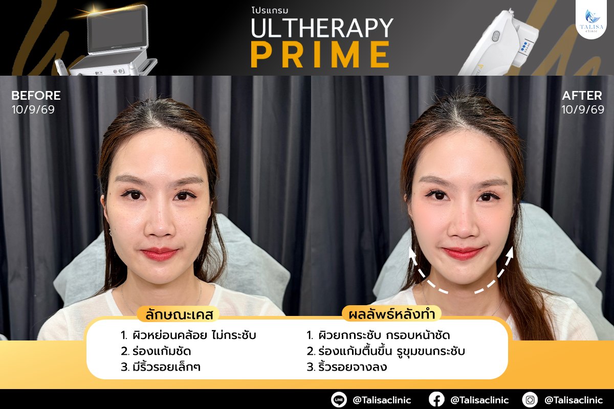 ภาพก่อนและหลังทำโปรแกรม Ultherapy Prime ของผู้ใช้บริการจริง เคสที่ 2