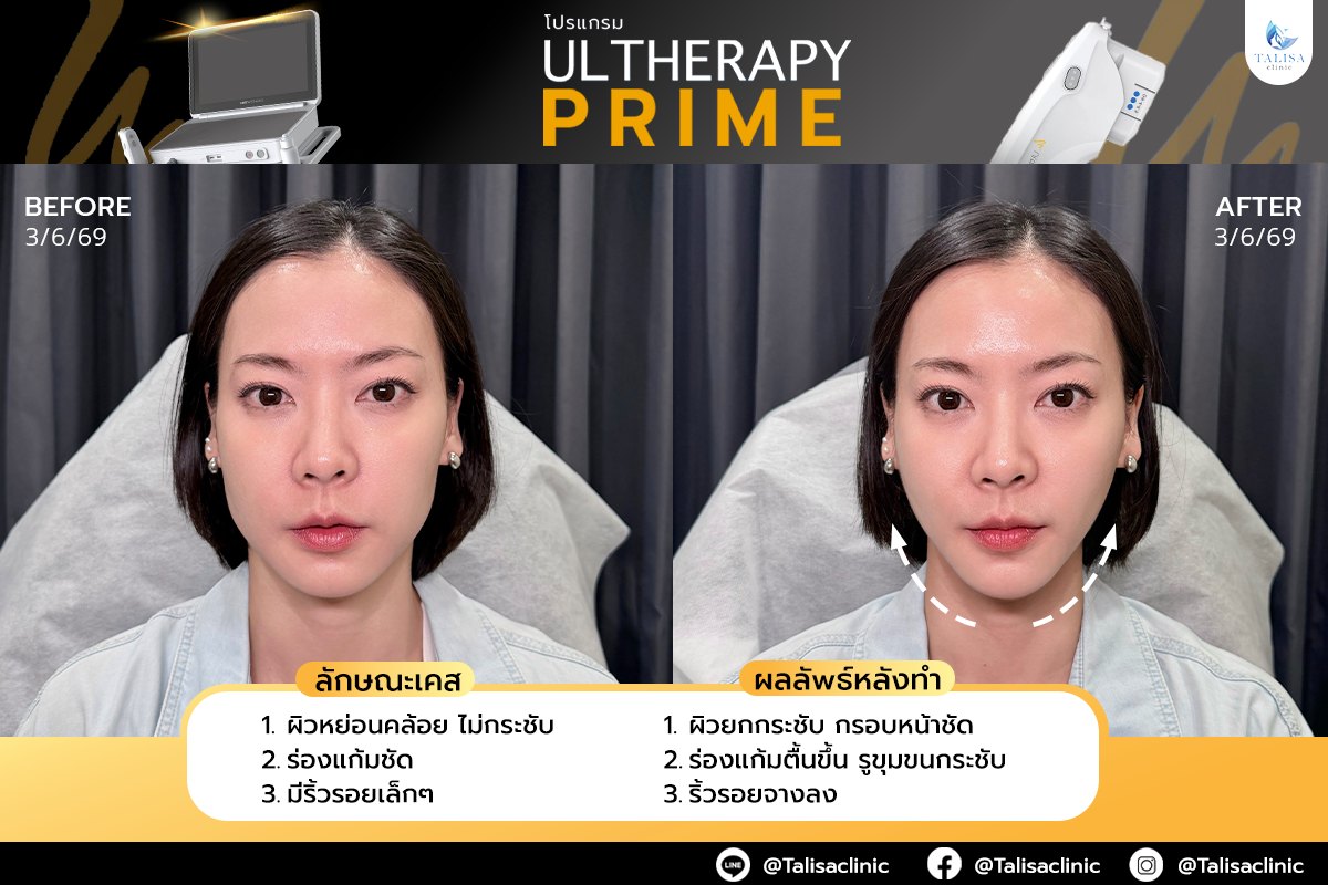 ภาพก่อนและหลังทำโปรแกรม Ultherapy Prime ของผู้ใช้บริการจริง เคสที่ 1