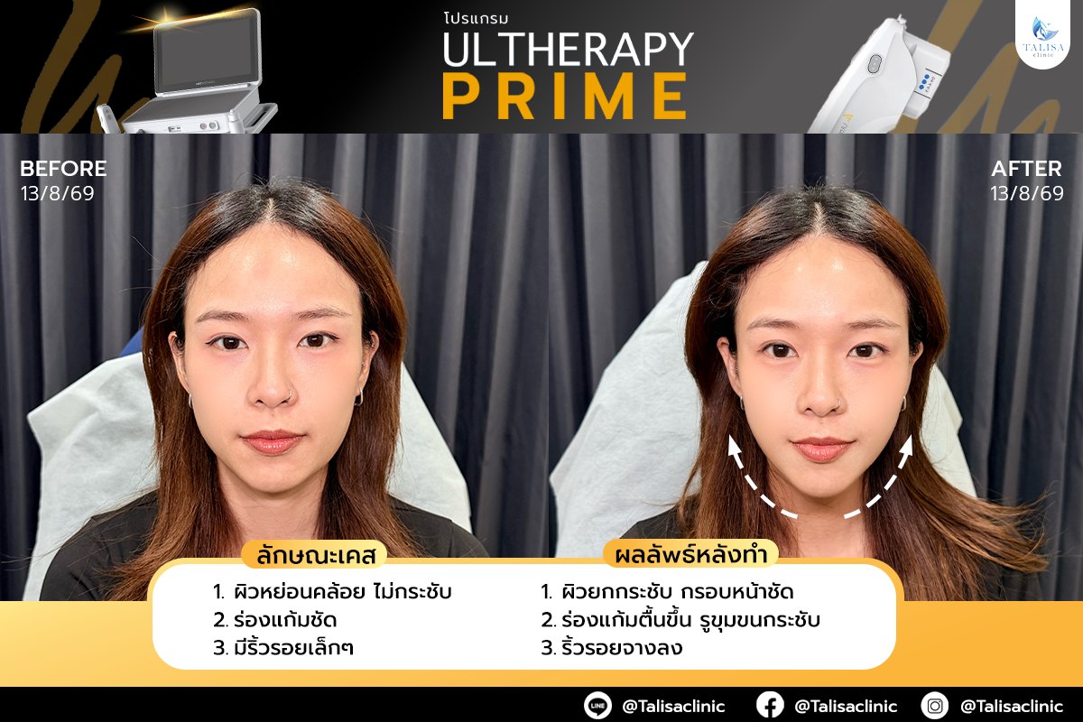 ภาพก่อนและหลังทำโปรแกรม Ultherapy Prime ของผู้ใช้บริการจริง เคสที่ 3